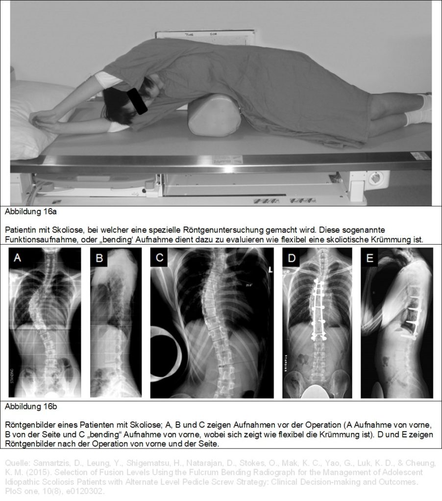 Idiopathische Skoliose Spinale Deformitäten